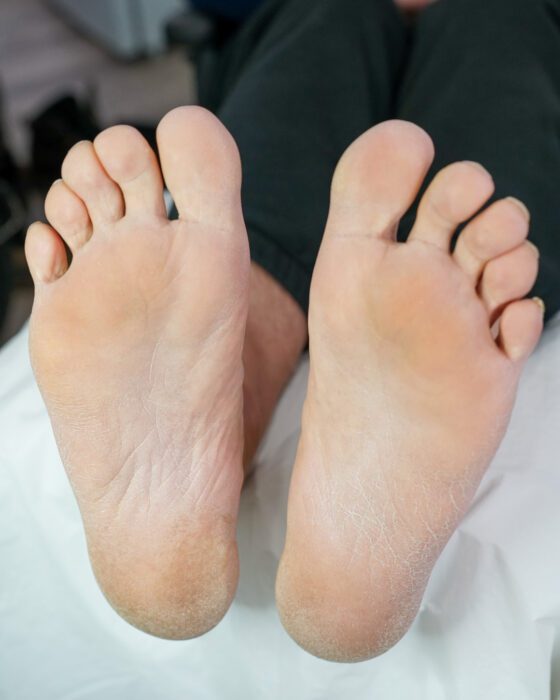 Before: both soles showing dry, flaking skin across the heels and the balls of the feet.