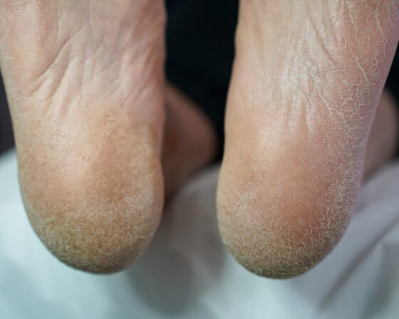Before, close view: hardened, flaking skin around both heel rims.