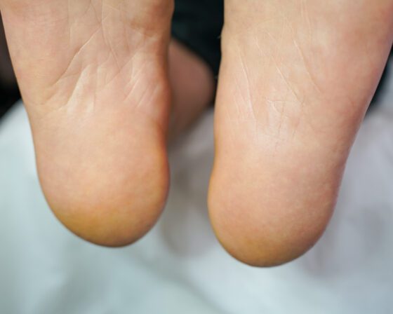 After, close view: heels sanded smooth, with no flaking left at the rims.