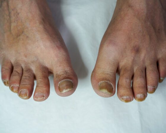Before: toenails long and thickened, with dry skin around the nail folds.