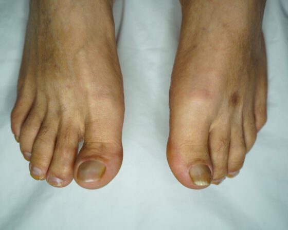 After: toenails shortened, thinned and shaped, with the nail folds cleaned.