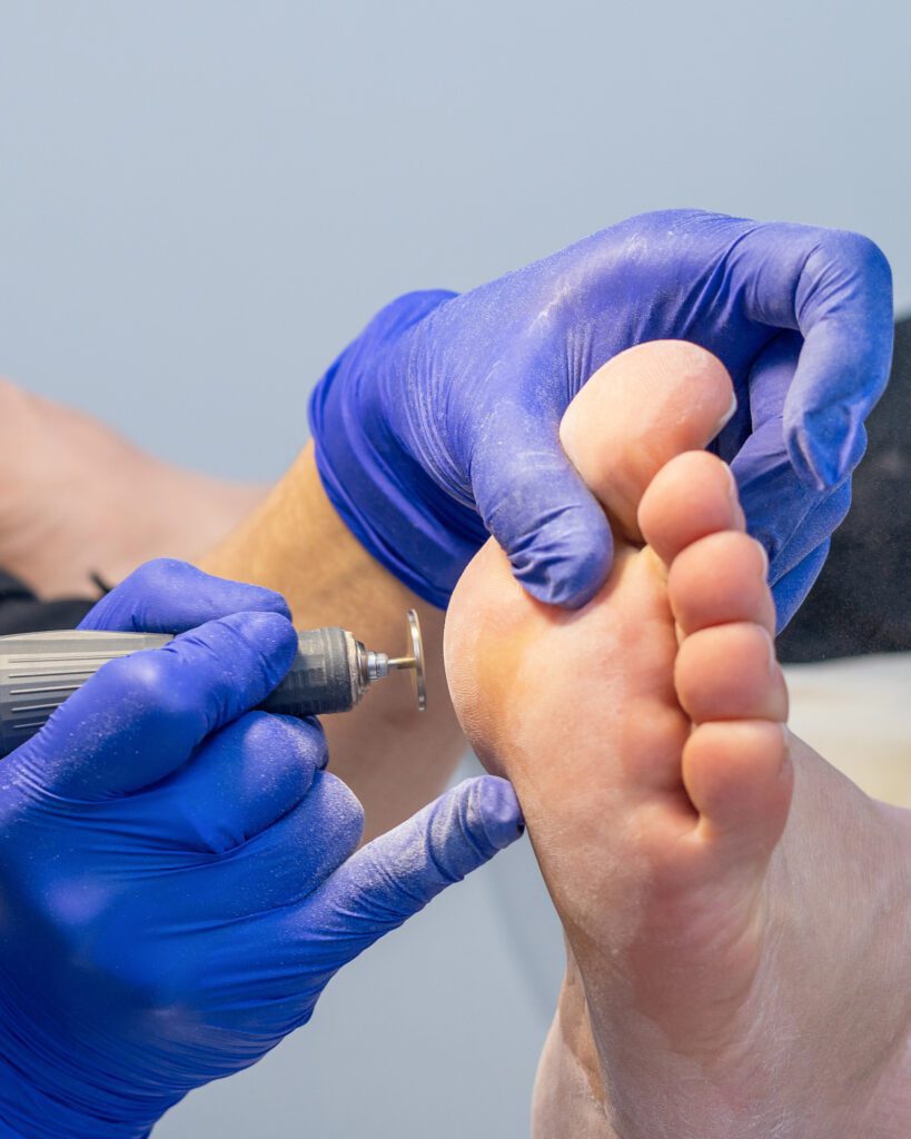 A technician in blue gloves using an electric file on the sole of a foot