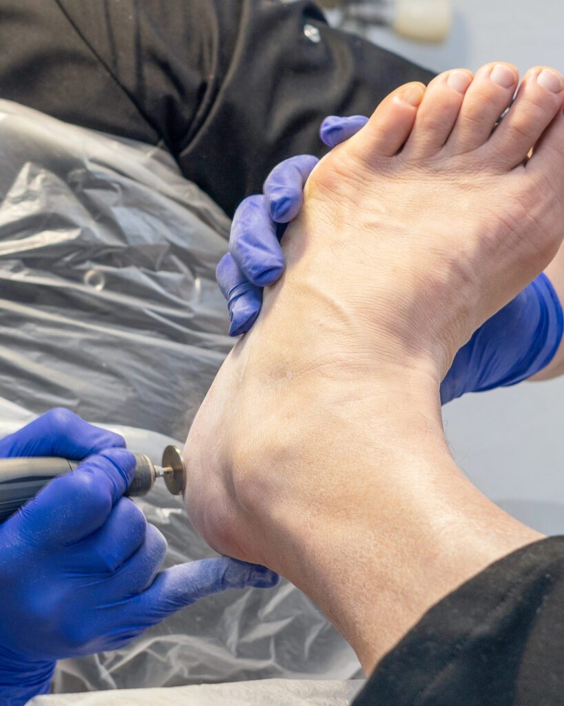 A technician in blue gloves treating the sole of a foot with a rotary tool over a protective cover