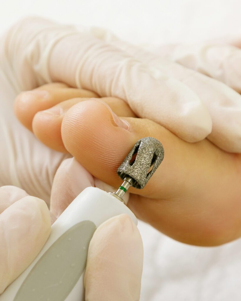 A gloved technician using a rotary sanding bit along the side of a foot