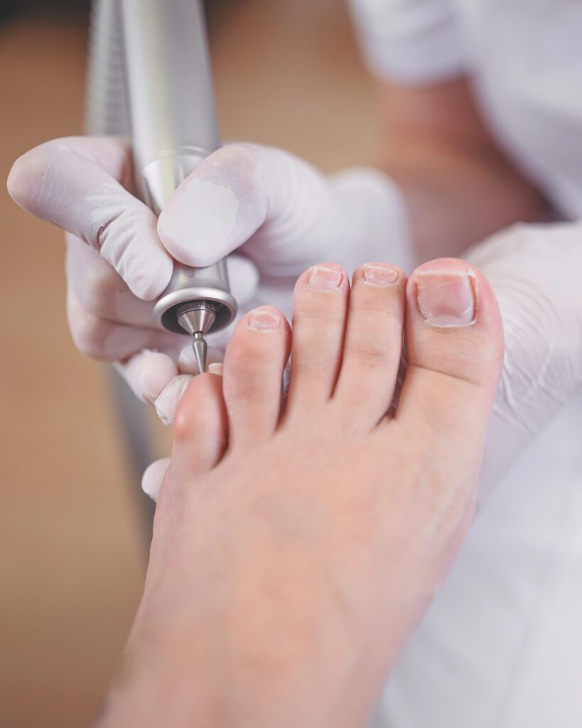 A gloved technician using a rotary tool on a toenail